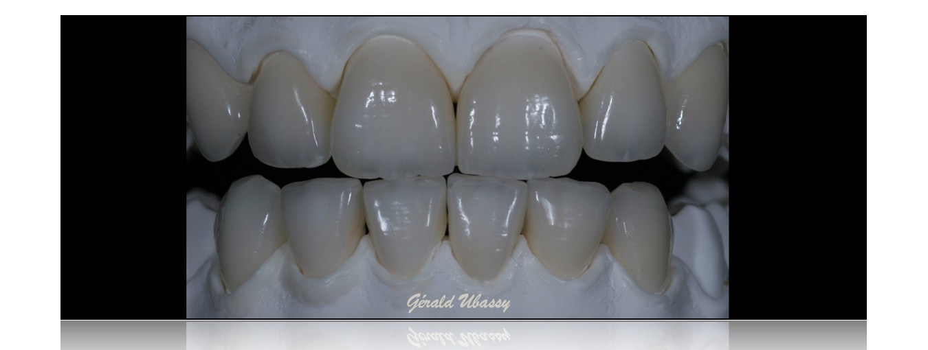 12 Veneers, Kina /Ubassy